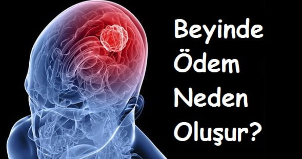 Beyinde Ödem Neden Oluşur