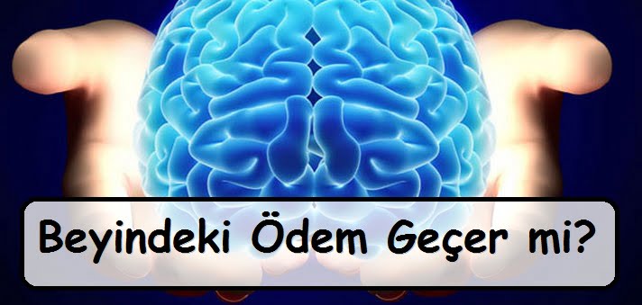 Beyindeki Ödem Geçer mi