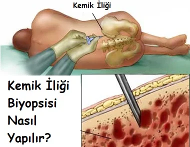 Kemik İliği Biyopsisi Nasıl Yapılır